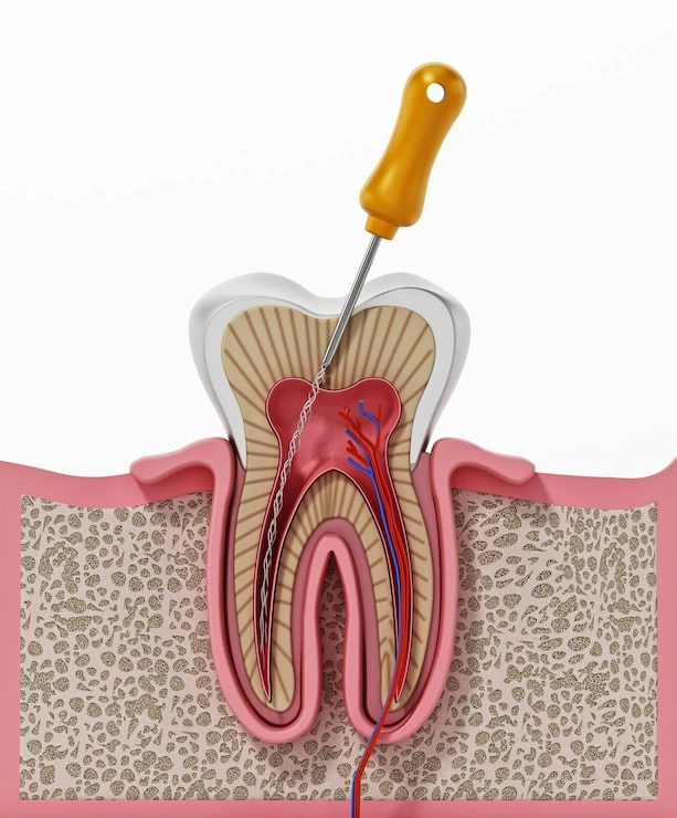 3d illustration root canal treatment process 613961 299