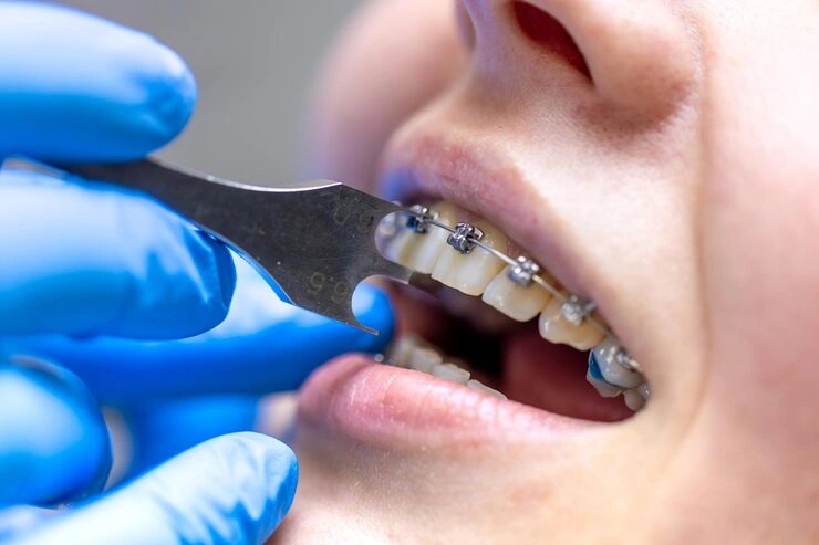 dental procedure installing braces close up dentistry braces teeth 169016 67450