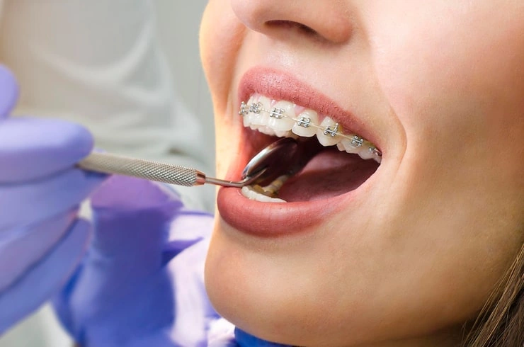 woman checks her teeth dental clinic puts braces 725455 408