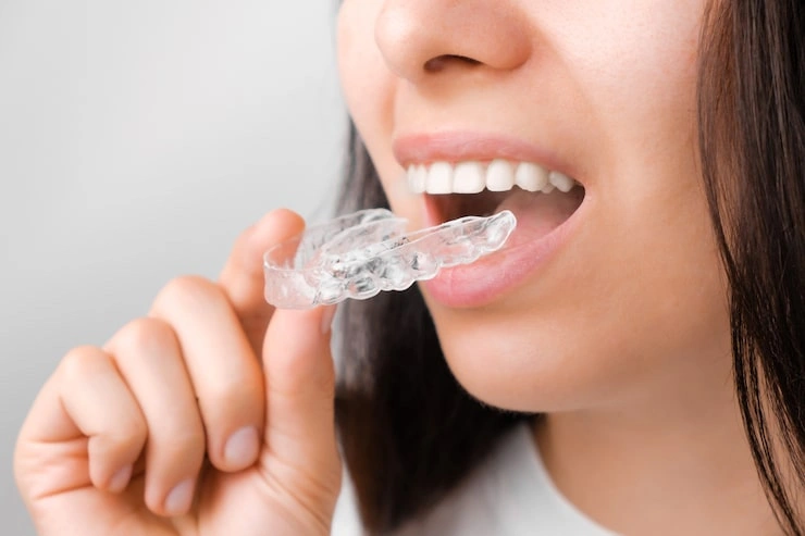young woman adjusting transparent aligners 177415 773 1